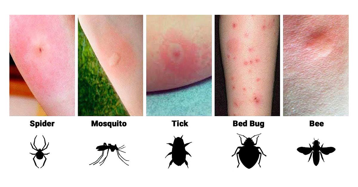 Different Types Of Insect Bites Insect Bites Types Prevention Different Types Of Insect Bites Insect Bites Types Prevention